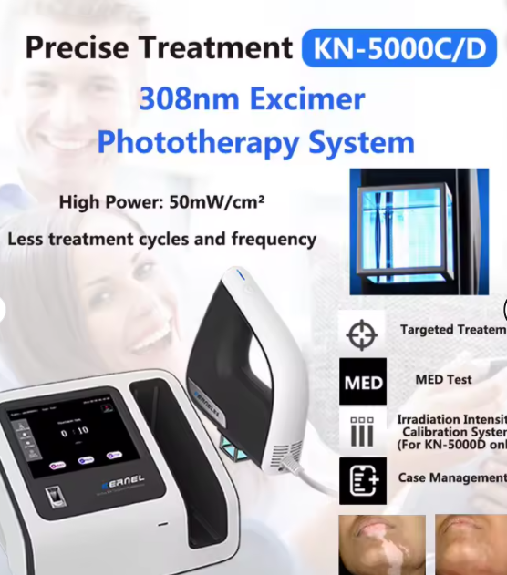 308 Nm Equipment Single Wavelength Excimer Light Output Via the Medium Xeci for Treatment Vitiligo Psoriasis