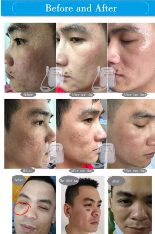 Anti-aging Skin Repair & Rejuvenation Instrument Ultra-micro Exfoliation Thermal Energy Equipment